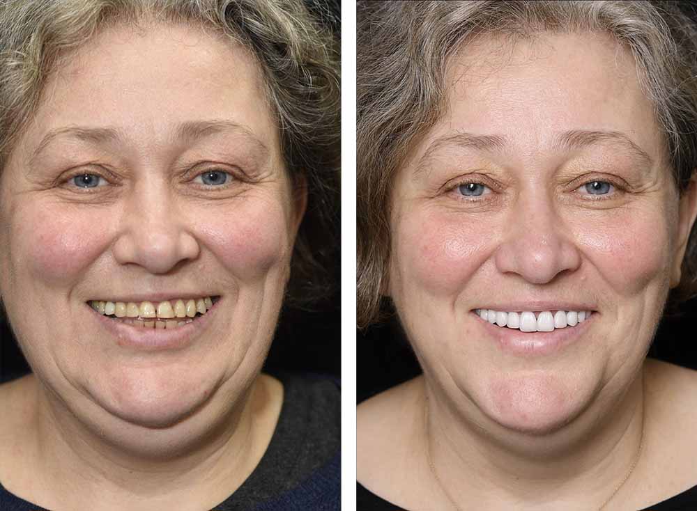 Ceramic rehabilitation before and after by Tetri's Smile