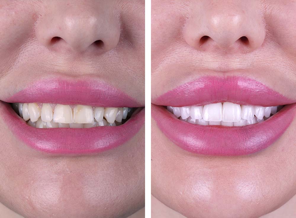 Smile transformation before and after by Tetri's Smile