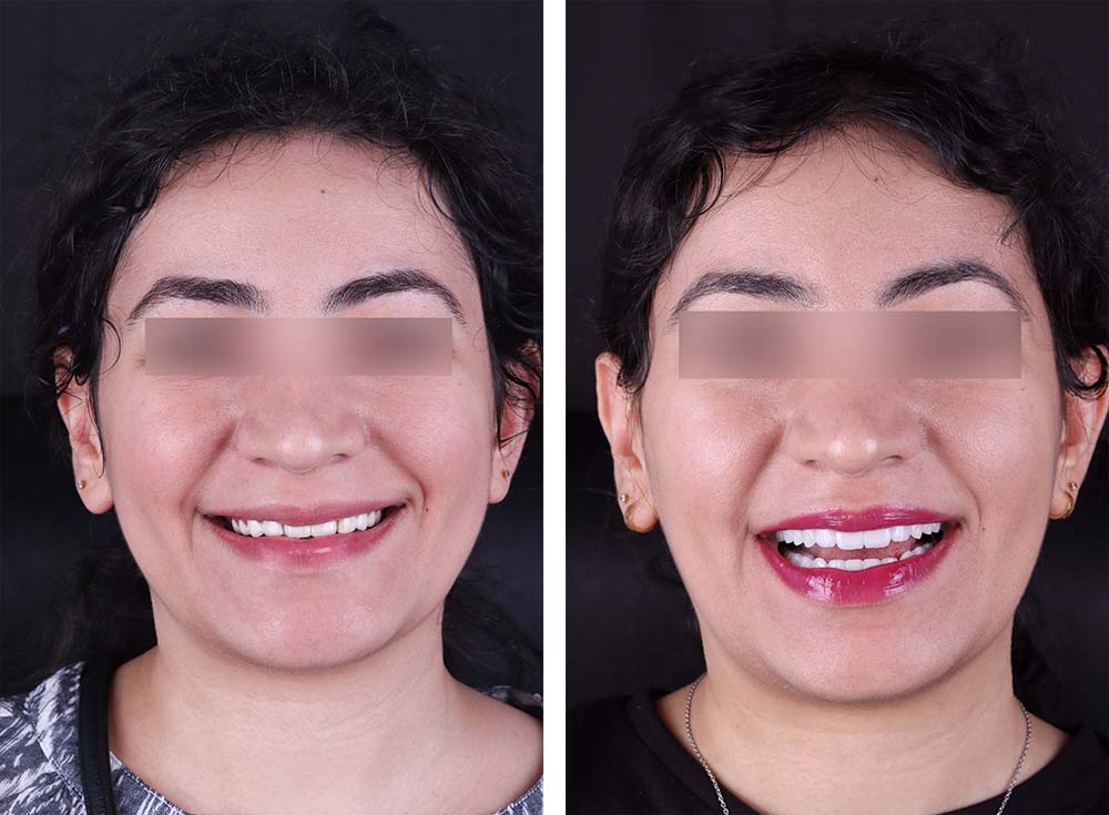 Full-mouth design before and after by Tetri's Smile